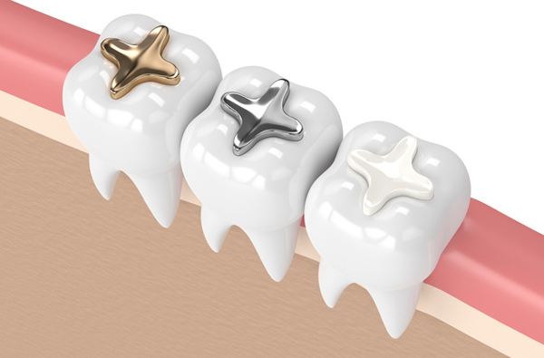 Rendering of teeth with 3 filling materials at Roane Family Dental.