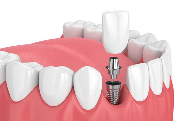Rendering of jaw with dental implant in West Linn, OR at Roane Family Dental.