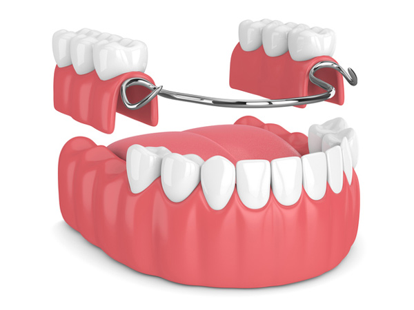 Rendering of removable partial denture at Roane Family Dental in West LinnAt Roane Family Dental 