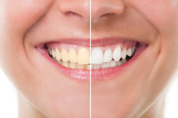 Before and after photo of teeth whitening treatment in West Linn, OR at Roane Family Dental.
