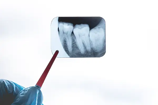 A dental X-ray image pointing to an impacted wisdom tooth illustrated by Roane Family Dental in West Linn, OR